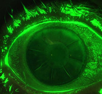 Corneal-Staining-Incision